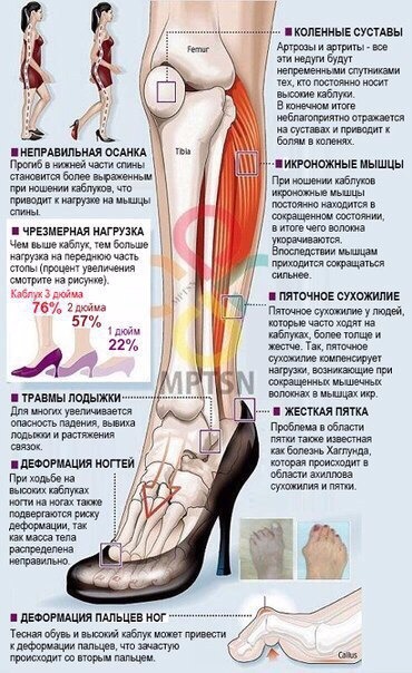 Высокий каблук и последствия ношения - Бодибилдинг форум AnabolicShops