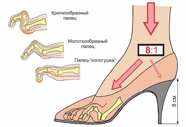 Высокий каблук и последствия ношения - Бодибилдинг форум AnabolicShops