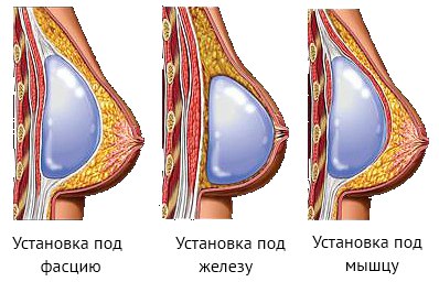 Пластика груди - Бодибилдинг форум AnabolicShops